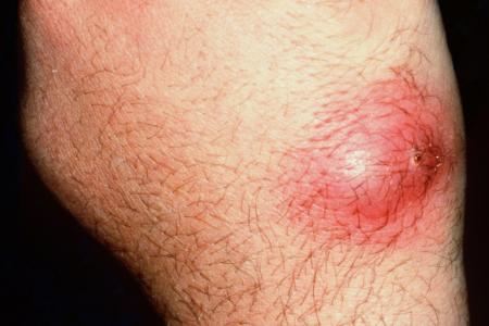 Boils and carbuncles | nidirect